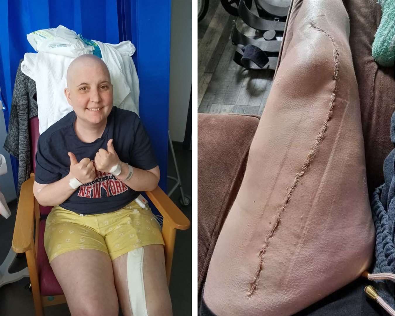 Beth Oxley (38) has gone through multiple rounds of brutal chemotherapy and had her left femur removed but a recent donation has given her hope of a long term cure.
