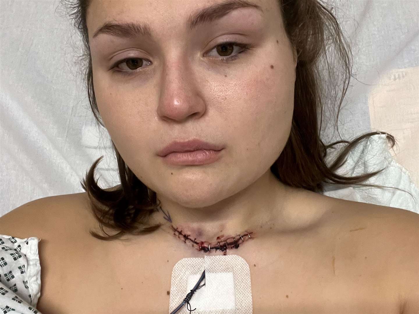 Megan Carr after her second surgery at William Harvey Hospital in Ashford