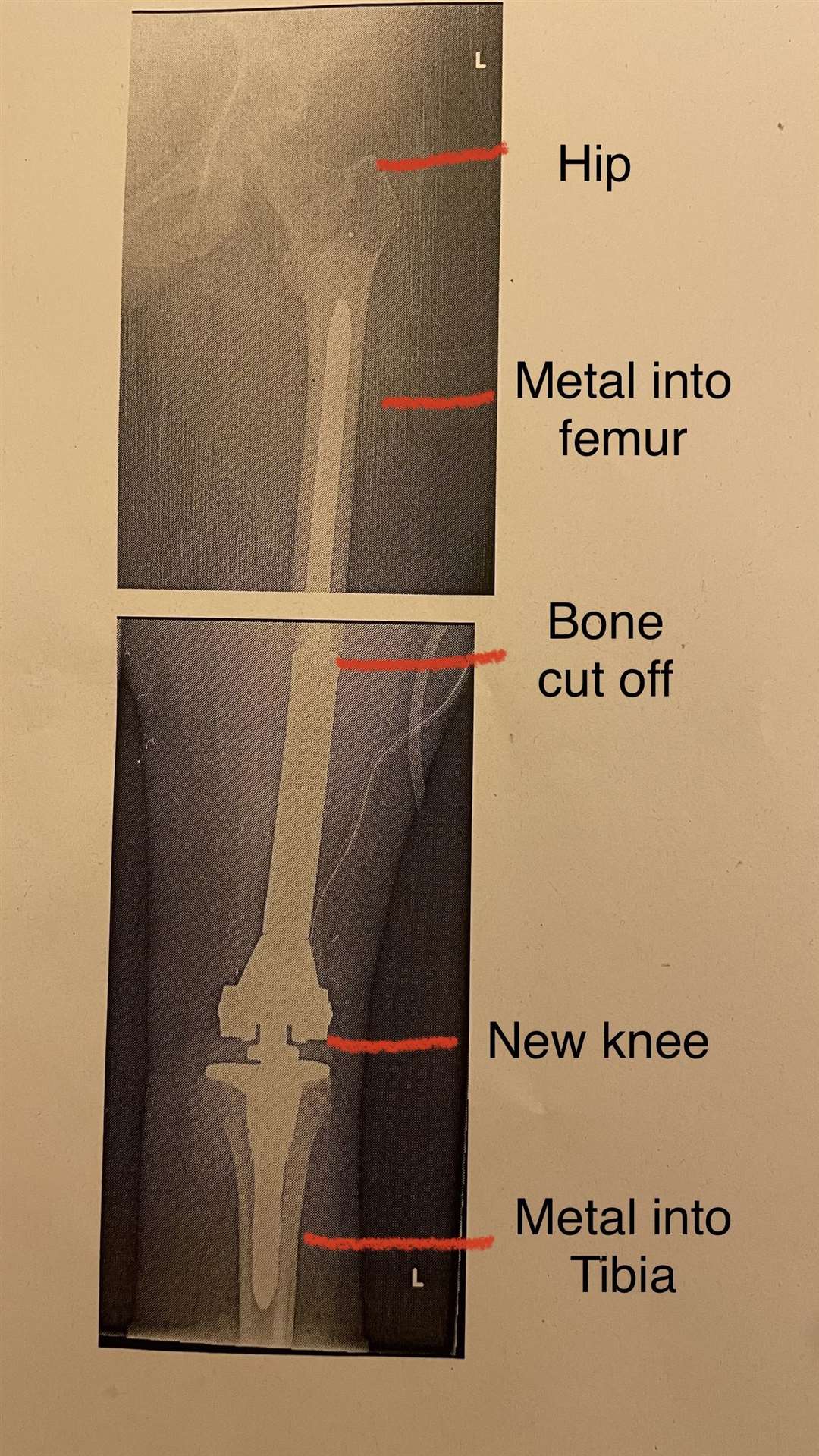 An X-ray of Beth's leg following her operation.