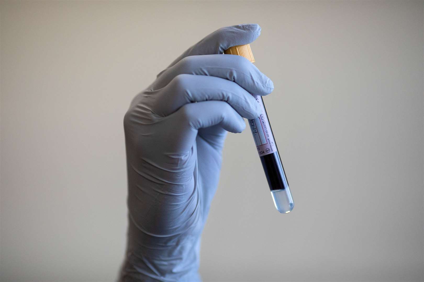 Jonathan Gullis’ Bill would allow a blood sample to be tested without the consent of the person it was taken from (Simon Dawson/PA) 